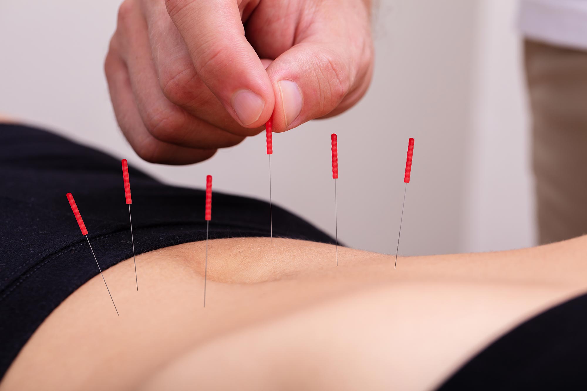 Dry Needling Acupuncture at Acu for Athletes