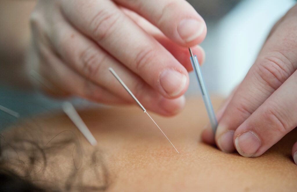 acupuncturist putting needles in patient back.