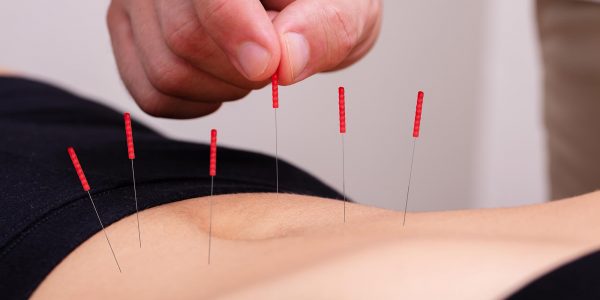 Dry Needling Acupuncture at Acu for Athletes